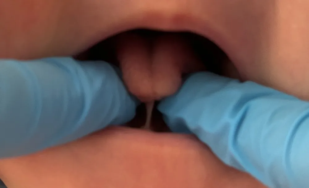 Frenillo lingual corto en un bebé: la punta de la lengua toma forma de corazón al levantarla