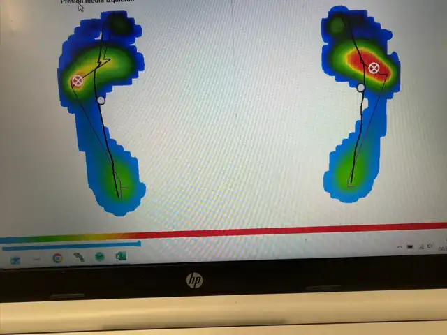 Mapa de presiones plantares de ambos pies obtenido en un estudio de la pisada en Alicante